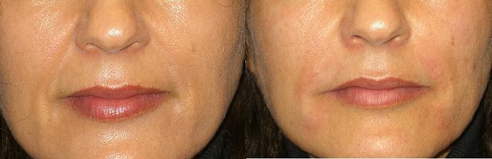 fillers hyaluronic cyprus.jpg